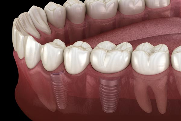 Multiple Teeth Dental Implants